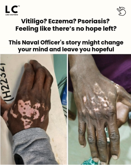 healing for psoriasis and eczema