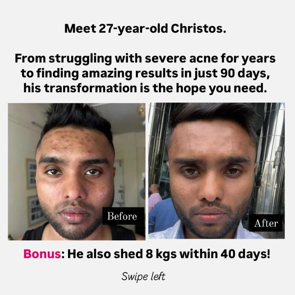 healing for psoriasis