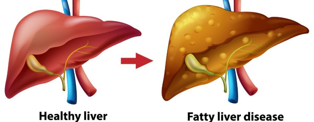 The Truth About Non-Alcoholic Fatty Liver Disease: What You’re Not Being Told|non-alcoholic-fatty-liver|non-alcoholic-fatty-liver