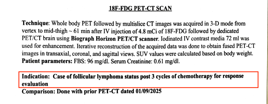 non-Hodgkin lymphoma