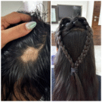 Alopecia at 10. 5 Bald Patches. Countless Tears. One Healing Protocol That Gave Her Hair Back.
